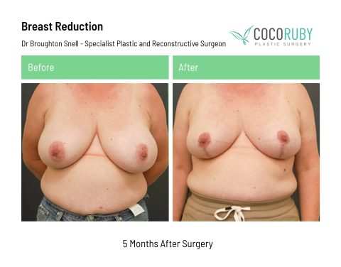 dr-broughton-snell-breast-reduction-14