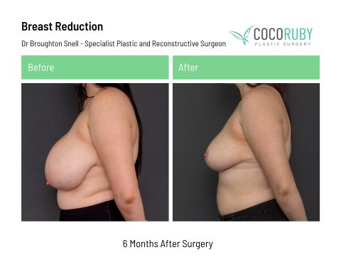 dr-broughton-snell-breast-reduction-2-1
