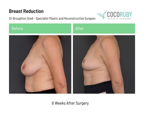 dr-broughton-snell-breast-reduction-21-1
