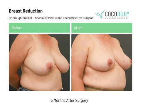 dr-broughton-snell-breast-reduction-22
