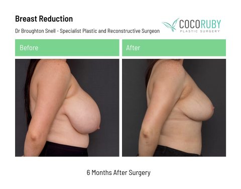 dr-broughton-snell-breast-reduction-3-1