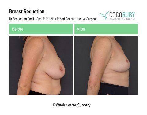 dr-broughton-snell-breast-reduction-31-1