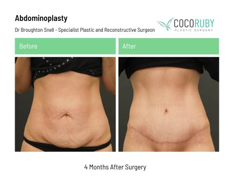 dr-broughton-snell-tummy-tuck-1