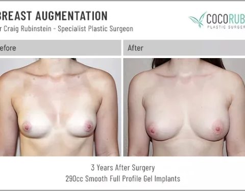 dr-craig-rubinstein-breast-augmentation-101