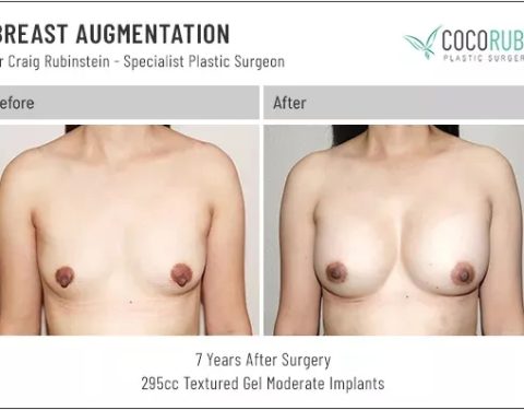 dr-craig-rubinstein-breast-augmentation-131