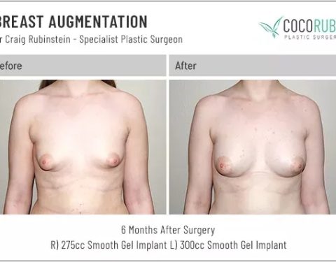 dr-craig-rubinstein-breast-augmentation-151