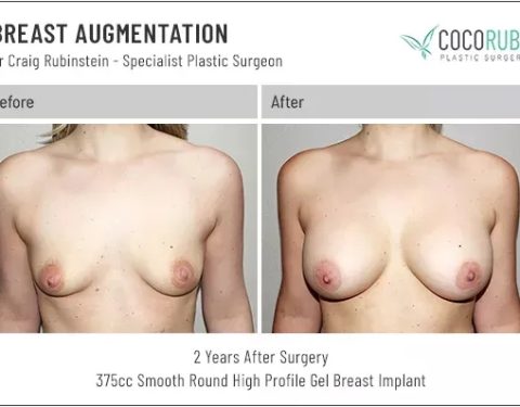 dr-craig-rubinstein-breast-augmentation-201