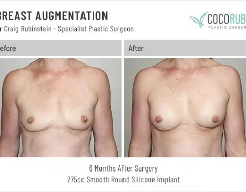 dr-craig-rubinstein-breast-augmentation-21