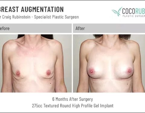 dr-craig-rubinstein-breast-augmentation-231
