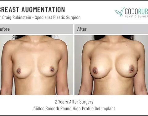 dr-craig-rubinstein-breast-augmentation-251