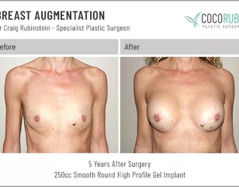 dr-craig-rubinstein-breast-augmentation-261
