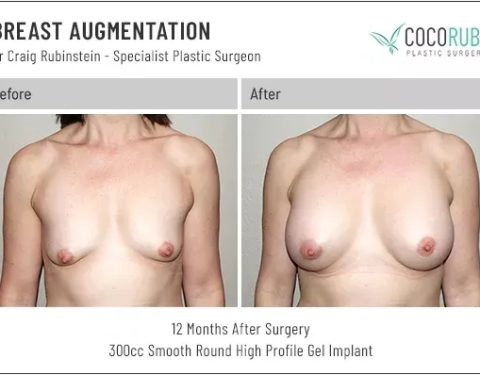 dr-craig-rubinstein-breast-augmentation-271