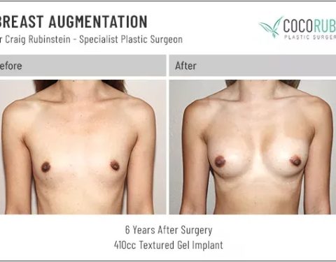 dr-craig-rubinstein-breast-augmentation-281