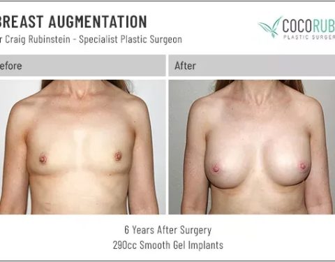 dr-craig-rubinstein-breast-augmentation-311