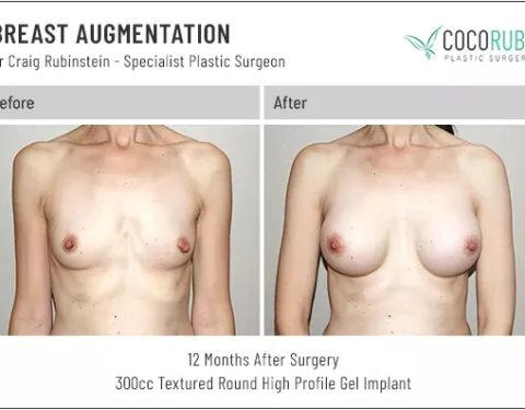 dr-craig-rubinstein-breast-augmentation-341