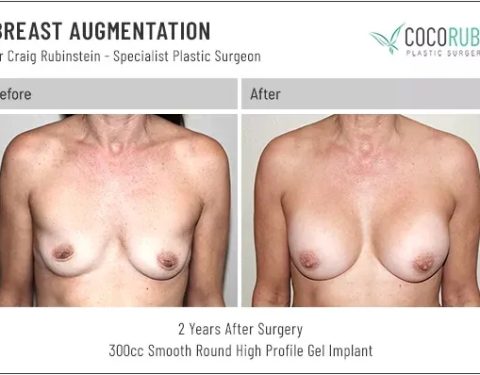 dr-craig-rubinstein-breast-augmentation-351