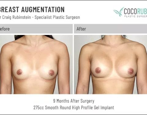 dr-craig-rubinstein-breast-augmentation-361