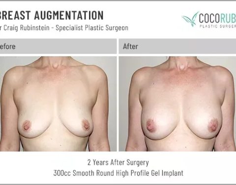 dr-craig-rubinstein-breast-augmentation-371