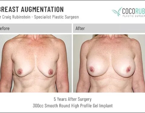 dr-craig-rubinstein-breast-augmentation-381