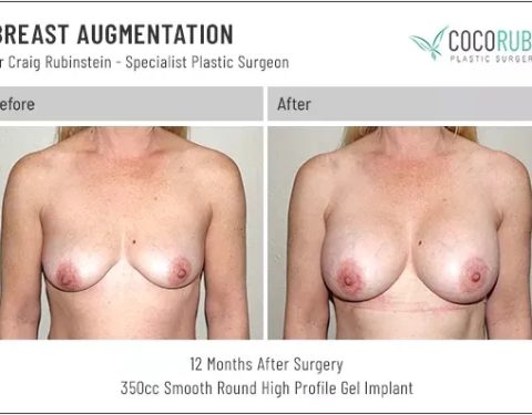 dr-craig-rubinstein-breast-augmentation-391