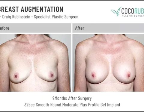 dr-craig-rubinstein-breast-augmentation-411