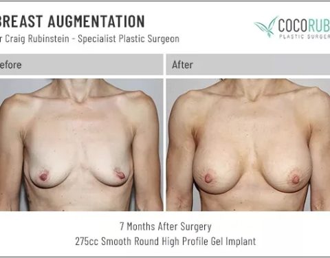 dr-craig-rubinstein-breast-augmentation-421