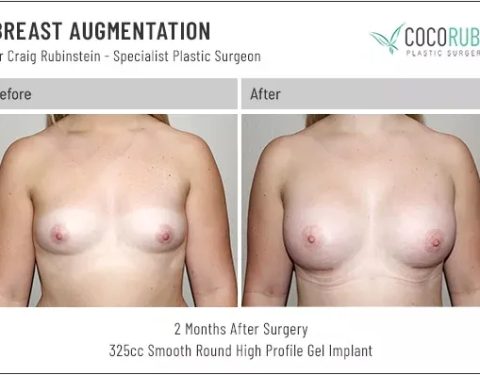 dr-craig-rubinstein-breast-augmentation-441