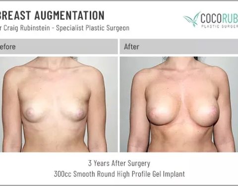 dr-craig-rubinstein-breast-augmentation-461