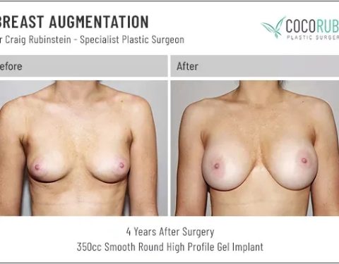 dr-craig-rubinstein-breast-augmentation-471