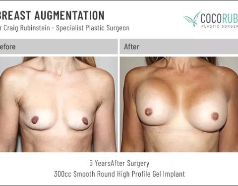 dr-craig-rubinstein-breast-augmentation-481