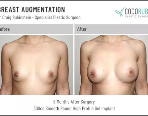 dr-craig-rubinstein-breast-augmentation-521