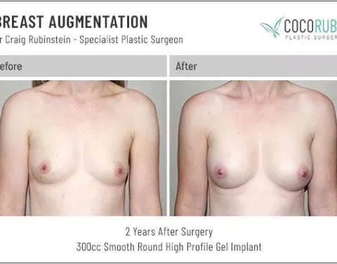 dr-craig-rubinstein-breast-augmentation-551