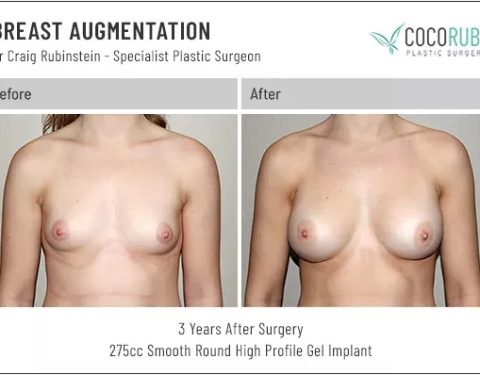 dr-craig-rubinstein-breast-augmentation-571