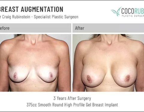 dr-craig-rubinstein-breast-augmentation-591