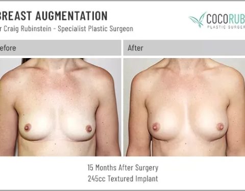 dr-craig-rubinstein-breast-augmentation-601