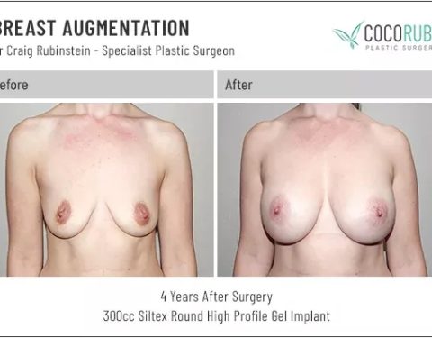 dr-craig-rubinstein-breast-augmentation-61