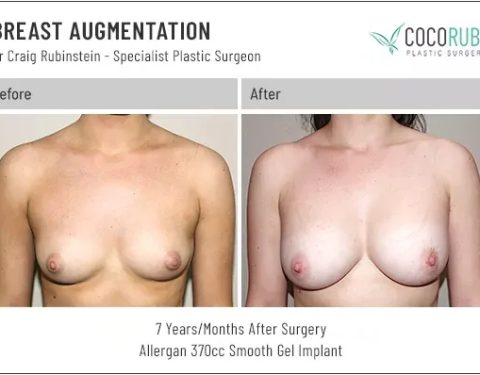 dr-craig-rubinstein-breast-augmentation-621