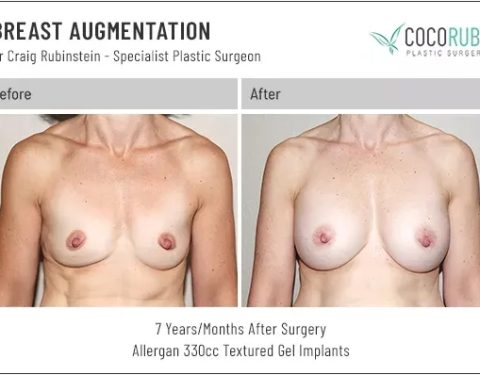 dr-craig-rubinstein-breast-augmentation-631