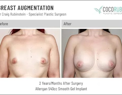 dr-craig-rubinstein-breast-augmentation-641