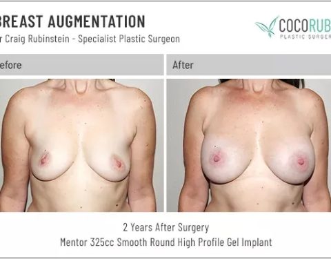 dr-craig-rubinstein-breast-augmentation-711