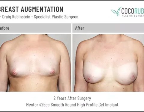 dr-craig-rubinstein-breast-augmentation-721