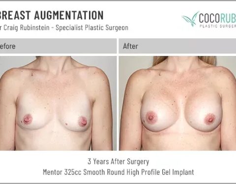 dr-craig-rubinstein-breast-augmentation-741