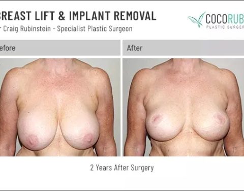 dr-craig-rubinstein-breast-lift-implant-removal-791