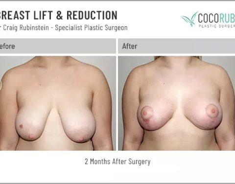 dr-craig-rubinstein-breast-lift-reduction-211