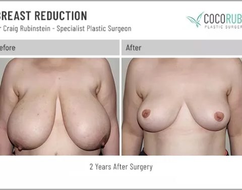 dr-craig-rubinstein-breast-reduction-11