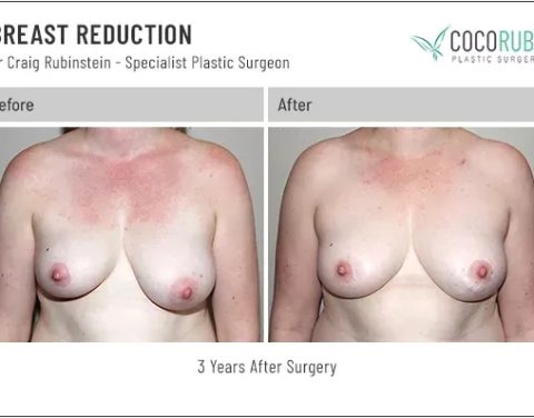 dr-craig-rubinstein-breast-reduction-221
