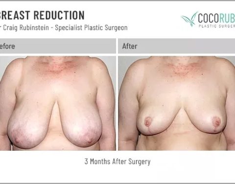 dr-craig-rubinstein-breast-reduction-301