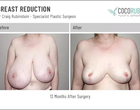 dr-craig-rubinstein-breast-reduction-41