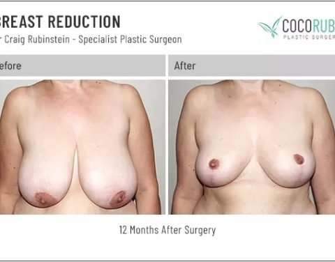 dr-craig-rubinstein-breast-reduction-51