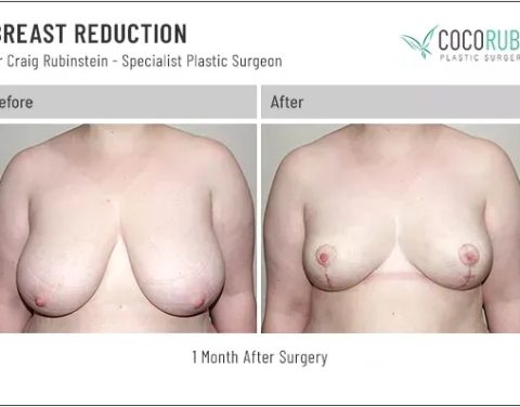 dr-craig-rubinstein-breast-reduction-541